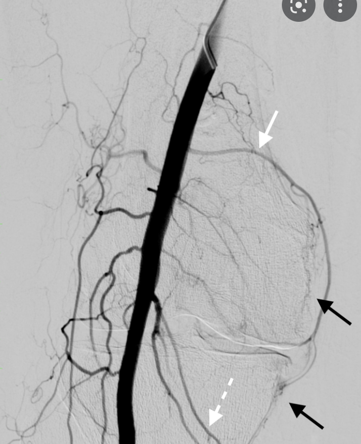 Une nouvelle frontière en radiologie interventionelle